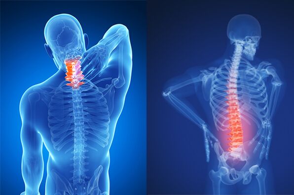 Osteochondrosis នៃឆ្អឹងខ្នងមាត់ស្បូននិងចង្កេះ