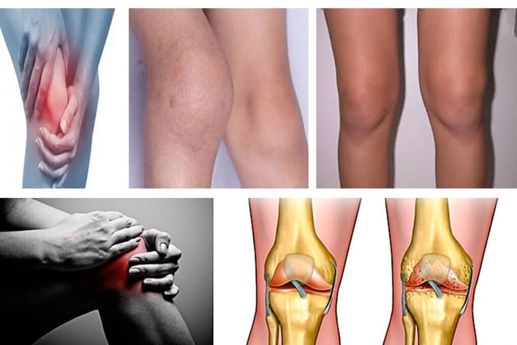 arthrosis តើវាជាអ្វី