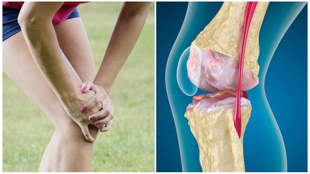 រោគសញ្ញា arthrosis